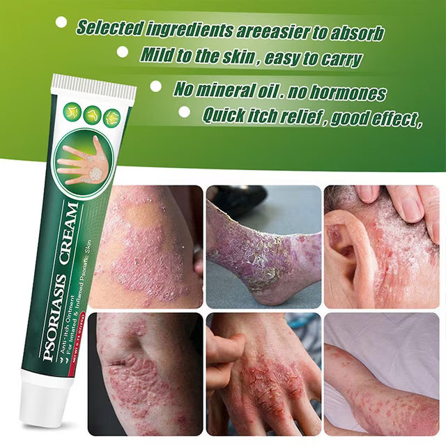 Alivia la Picazón- Crema Antipicazón - ENVIO GRATIS 🚚